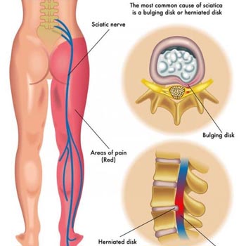 Effective sciatica pain relief treatments for leg and back pain